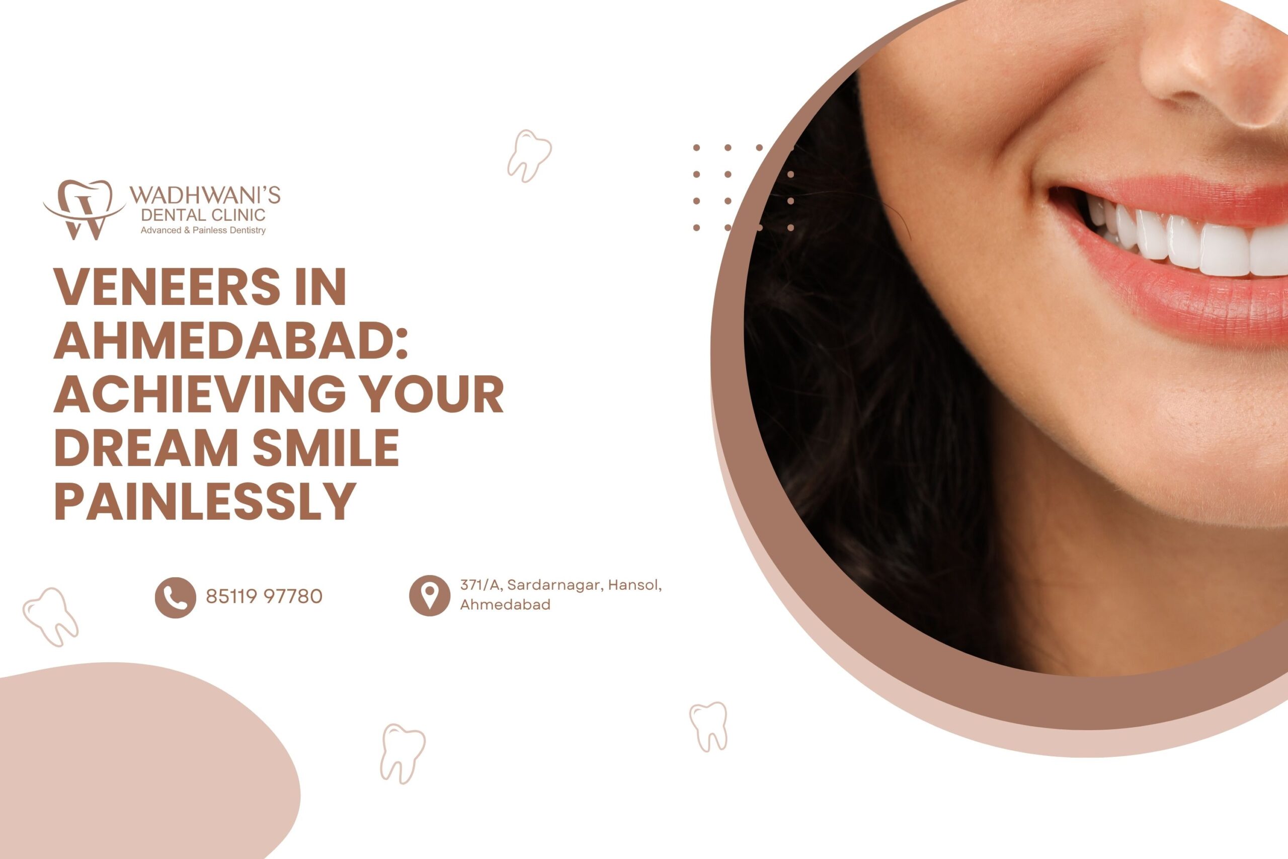 Veneers in Ahmedabad: Achieving Your Dream Smile Painlessly