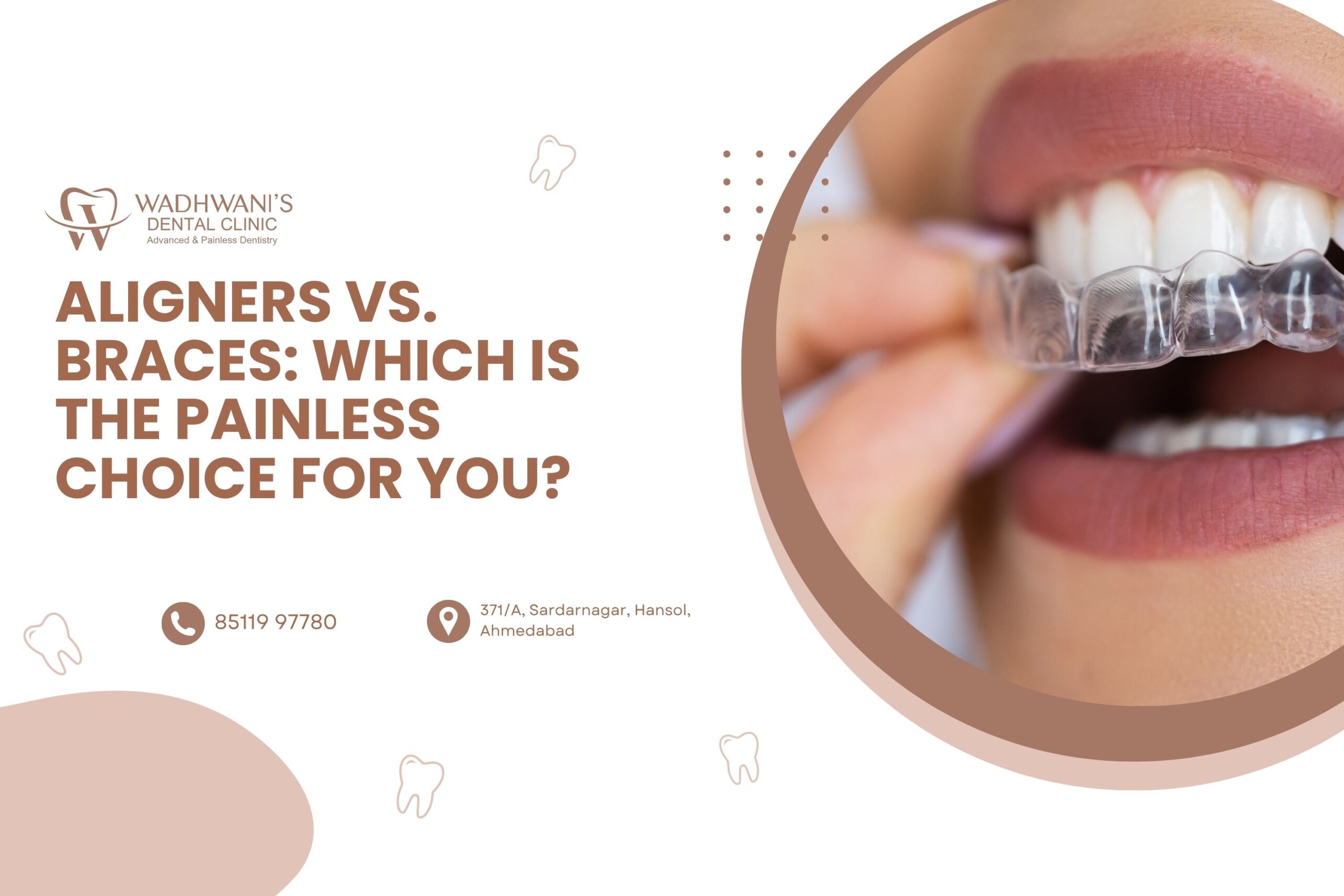 Aligners vs. Braces: Which is the Painless Choice for You?
