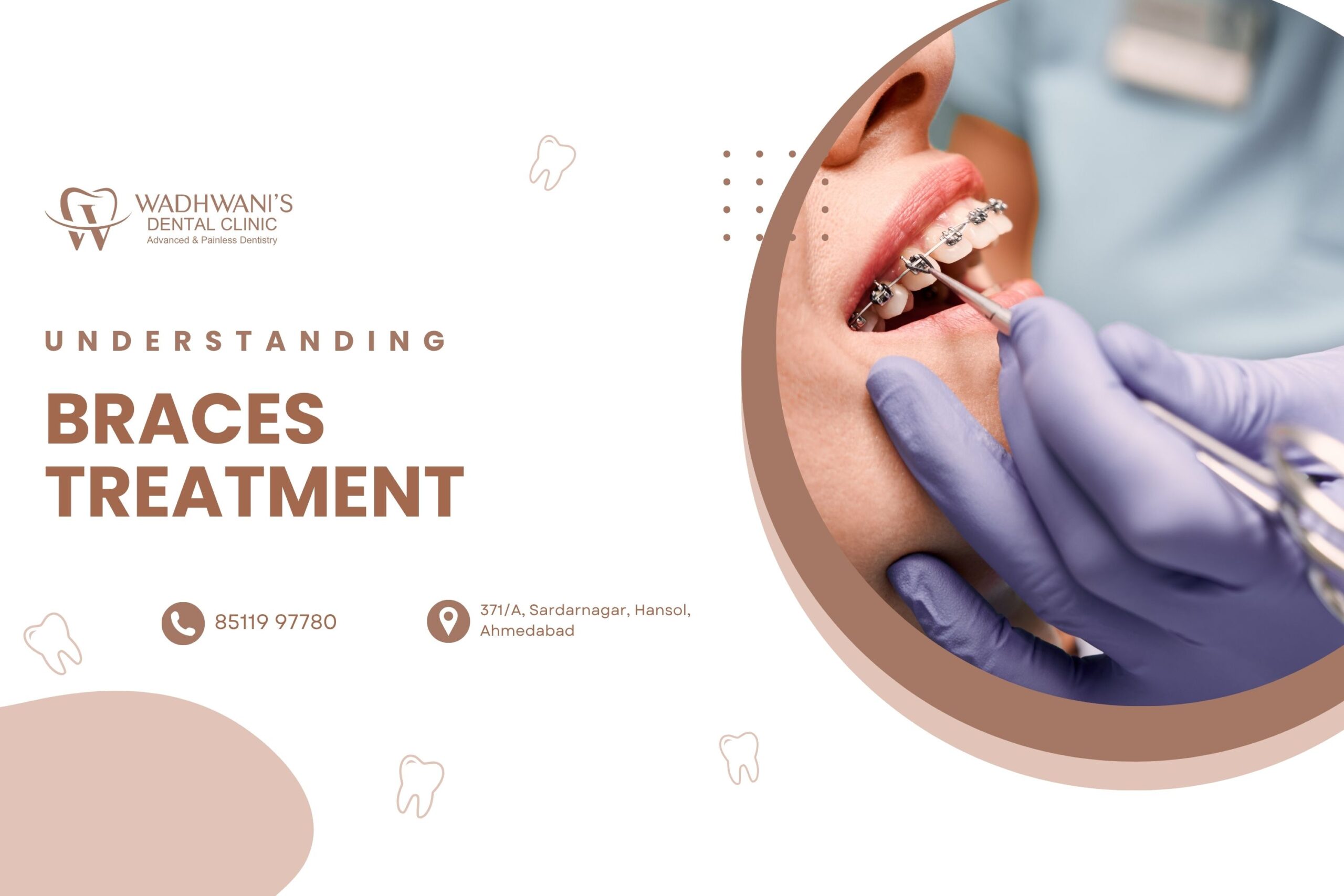 Understanding the Process of Getting Braces: A Painless Journey with Dr. Ashwini Wadhwani