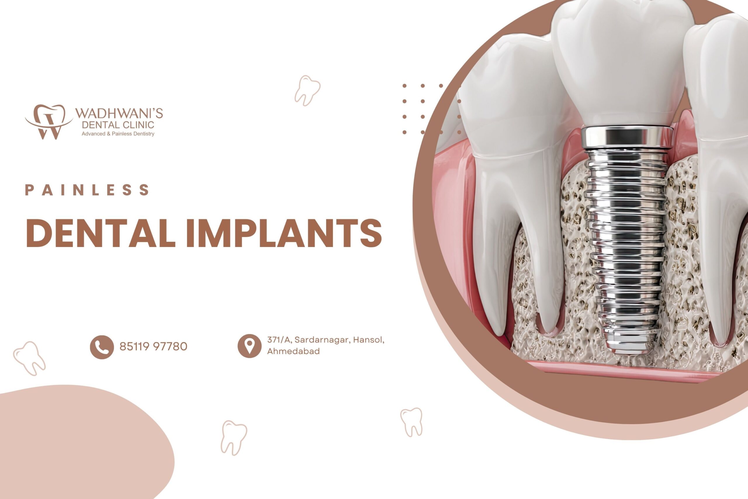 Painless Dental Implants: Transform Your Smile with Dr. Ashwini Wadhwani